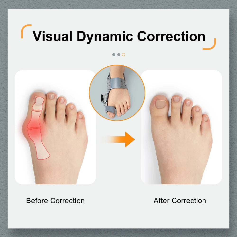 Adjustable Bunion Corrector